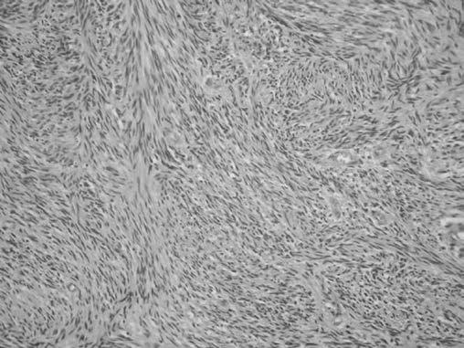 0. ULUSAL KANSER KONGRESİ POSTER BİLDİRİLER ker olarak görev yapan interstisyel Cajal hücrelerinden kaynaklanırlar.