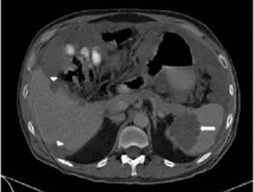 0. ULUSAL KANSER KONGRESİ POSTER BİLDİRİLER yönelik yapılan bilgisayarlı tomografide (BT) karaciğer yüzeyinde ve dalakta septalı sıvı dansitesinde lezyonlar izlendi (Şekil ).