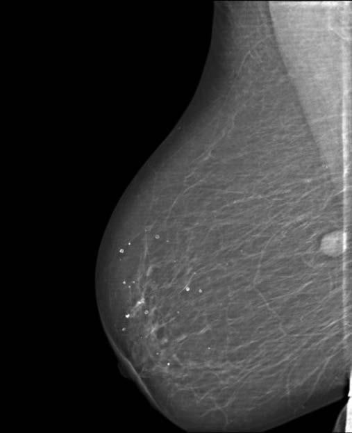 0. ULUSAL KANSER KONGRESİ POSTER BİLDİRİLER memede yeni tutulum saptadık. Fizik muayenede ele gelmeyen bu kitleye mammografi- meme ultarsonu ve ardından tru-cut biyopsi yaptırdık.