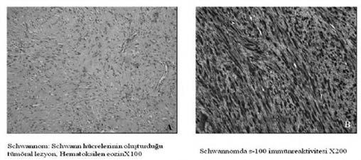 Tartışma: Schwannomlar nöral kılıftan köken alan, çok nadir olarak retroperitoneal alanda yerleşim gösteren nadir görülen tümörlerdir.