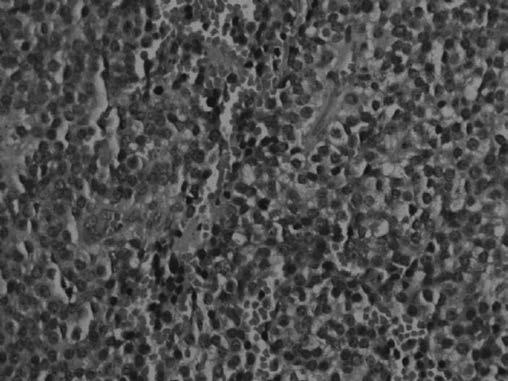 PEDİYATRİK TÜMÖRLER POSTER BİLDİRİLER Şekil. Prolaktinoma; Mikroskopik Görüntüsü Tablo.