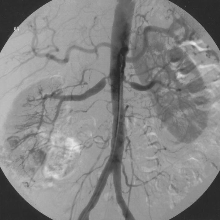 focal stenoses Intimal/Medial fibroplasia a focal, concentric stenosis Aortorenal dissection Vasculitis