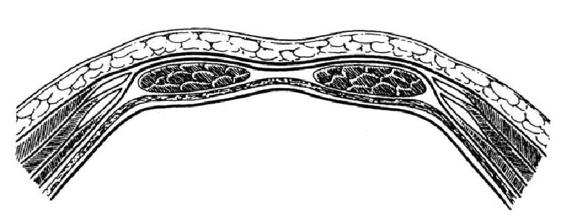 obliquus internus abdomis kas n n aponevrozu ise rektus kas n n lateral kenar nda iki yapra a ayr l r ve rektus kas n hem önden hem arkadan kuflatarak linea alba da karfl efliyle birleflir. M.