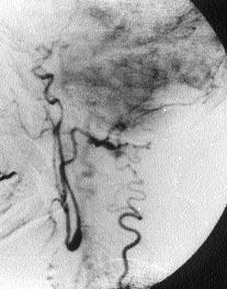 Sol subklavyan arter anteroposterior (A) and lateral () anjiyografilerinde EKA ve KA n n, SKA ve vertebral arterin oksipital arterle oluflturdu u musküler anastomozlar yoluyla gösterdi i