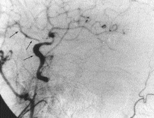 Sadece İKA ve diğer arter oklüzyonlar ile birlikte olan toplam 20 İKA oklüzyonunun 13 ünde (%65) oftalmik arterde, internal maksiller arter ile oftalmik arter aras ndaki etmoidal anastomozlar n