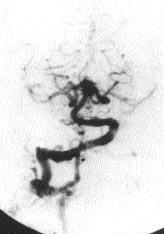 A Resim 5. Sa vertebral arter anteroposterior (A) ve lateral () anjiyografilerinde moya moya hastal olan olguda PkoA n n patent oldu u izlenmektedir.