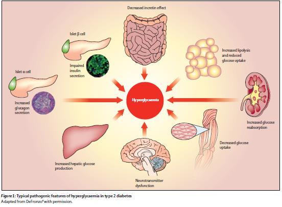 Hiperglisemi Patogenezinde Glukagon un Yeri Azalmış inkretin etkisi Artmış glukagon sekresyonu Bozulmuş İnsülin sekresyonu hiperglisemi Artmış lipoliz ve
