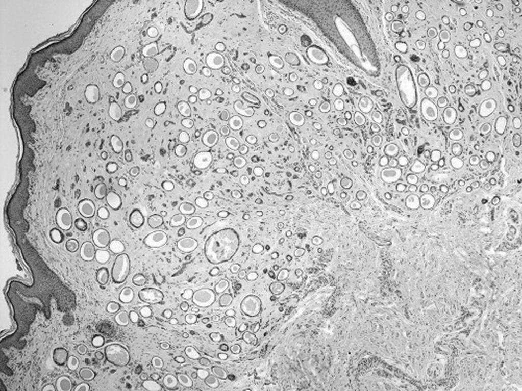 The histological examination of the hysterectomy specimen was unremarkable but the vulvar lesion was determined to be syringoma (Figure 2 and 3).