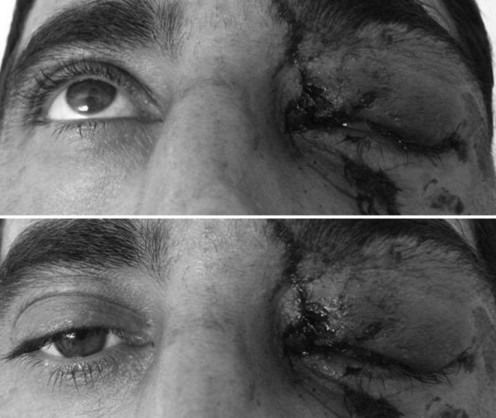 Figure 1. Appearance of the patient in emergency room. Upper left eyelid was not moving upword. Figure 3. The appearance of the eyelid after six months during upward and downward gaze. Figure 4.