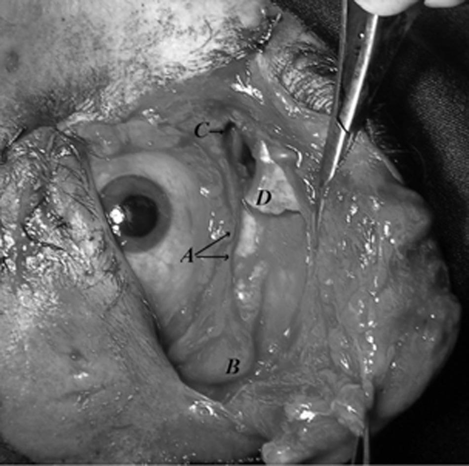 The appearance of the injury following the removal of previously placed sutures: A) Superior fornix conjunctiva and levator palpebrae superioris muscle complex; B) Lacrimal gland; C) Opening of the