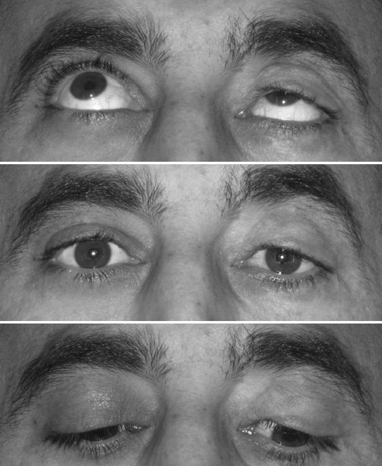 Discussion Traumatic ptosis is common after deep eyelid lacerations and avulsions.