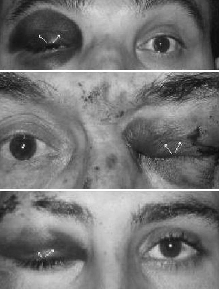 Figure 5. Three different patients with orbital trauma. Note that the skin crease is preserved despite periorbital edema and ecchymosis (arrows).