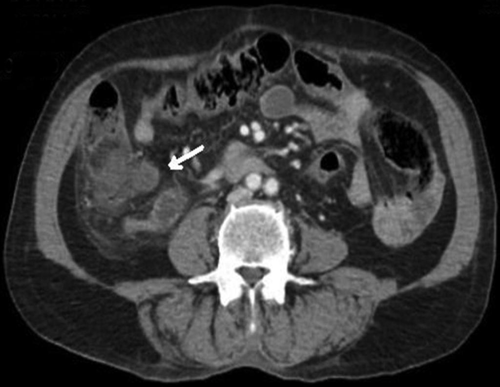 Figure 1. Appearance of dirty mesentery in the right lower quadrant (arrow). Figure 2. Appendectomy specimen.