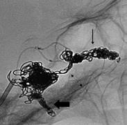 Dural Arteriovenöz Fistüllerde Endovasküler Tedavi 79 A B C D E Resim 2. A-F. Sağda dural KKF bulunan 55 yaşında bayan hasta.