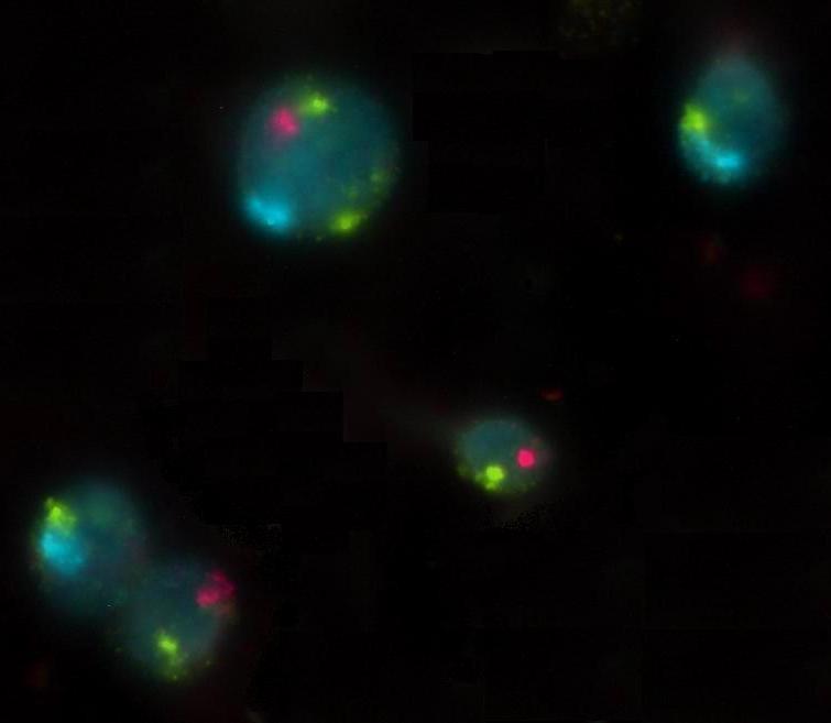 18Y sperm Lenfosit 18Y sperm 18X sperm 18X sperm Şekil 7. Sperm çekirdeğine üç renkli 18XY sentromerik prob ile yapılan floresan in situ hibridizasyon (FISH).