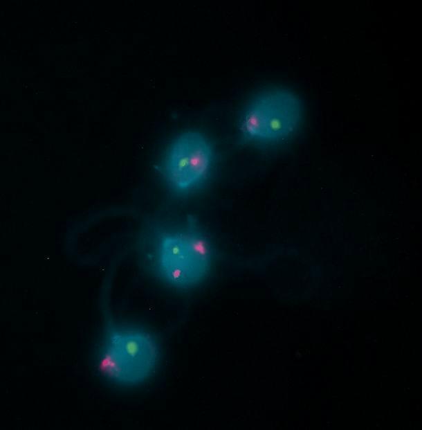 Şekil 11. Sperm çekirdeğine 13-21 lokus spesifik prob ile yapılan floresan in situ hibridizasyonda (FISH) dizomi 21 gözükmektedir.