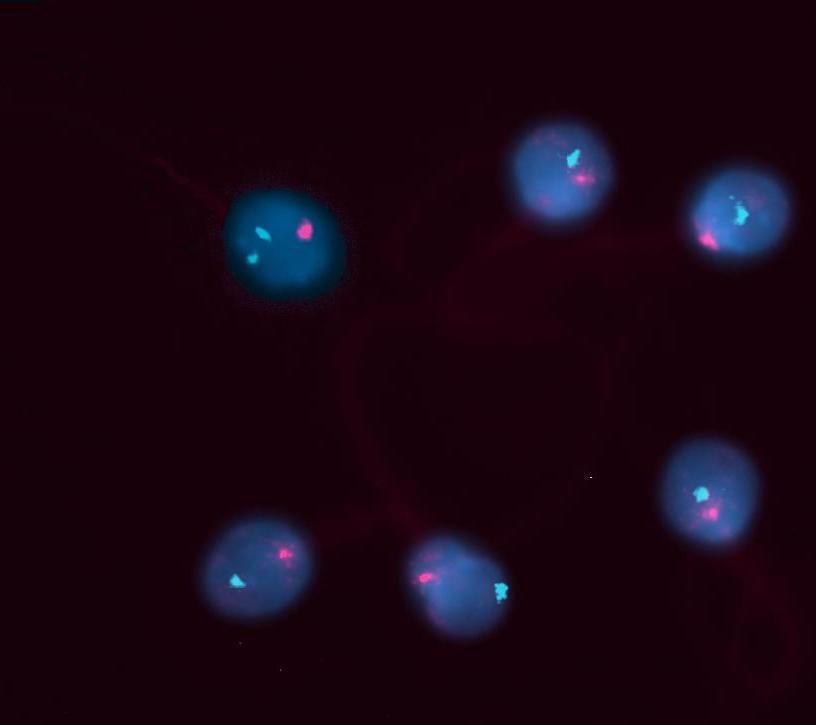 Şekil 13. Sperm çekirdeğine 3-17 sentromerik prob ile yapılan floresan in situ hibridizasyonda (FISH) dizomi 17 gözükmektedir.