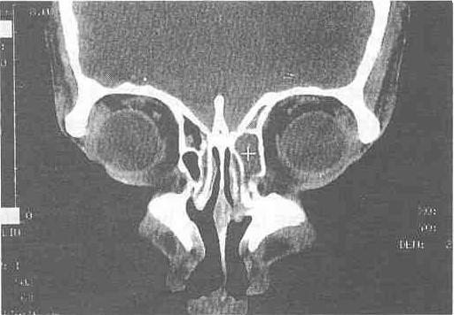 erkek hasta (Preoperatif CT) Bilateral solda daha belirgin ve infekte agger nazi hücresi Tablo-3. Kıvnntıh uncinate process varyasyonunun ayrıntılı değerlendirilmesi nj : taraf sayısı R.