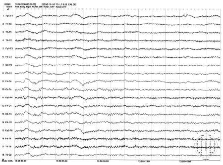 EEG) sadece hemisfer arka yarılarında 6-7 Hz teta ritminden oluşan temel aktivite göstermekte idi. Epileptiform aktiviteler ve ağır yavaş dalga aktivitesi koybolmuştu.