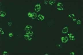 10.8. ANCA - sitoplazmik boyanma birlikteliği 10. SİSTEMİK VASKÜLİTLER VE TANIDA KULLANILAN OTOANTİKORLAR Mikroskobik görünüm İlgili antijenler İlişkili olduğu hastalıklar Resim 10.8.1. Etanolle fikse granülositler (x40) Resim 10.