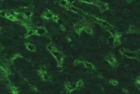 ) Resim 5.1.2.1.4. HEp-2 (x40) HEp-2 interfaz evresindeki hücreler: Pozitif İstirahat halindeki hücre nükleuslarında nükleoplazma yoğun ince benekli tarzda boyanma gösterir.