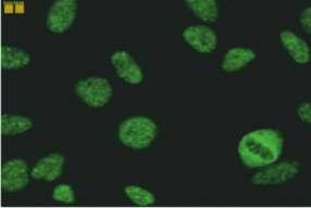 5.1.2.3. İnce benekli patern (Anti-Ku benzeri boyanma) Resim 5.1.2.3.1. HEp-2 (x40) Resim 5.1.2.3.2. Maymun karaciğeri (x40) Mikroskobik görünüm İlgili antijenler İlişkili olduğu hastalıklar Resim 5.