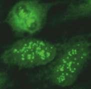 HEp-2 metafaz evresindeki hücreler: Pozitif Bölünen hücrelerdeki kromatinlerde belirgin, tipik, noktalı tarzda boyanma görülür.