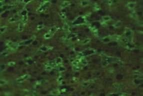 HEp-2 (x40) Mikroskobik görünüm İlgili antijenler İlişkili olduğu hastalıklar HEp-2 interfaz evresindeki hücreler: Pozitif G fazındaki hücrelerde kuvvetli, G fazındaki hücrelerde zayıf / negatif ince
