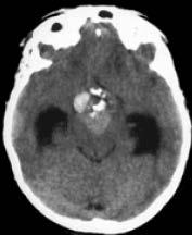 Oligodendroglioma %90 Metastaz