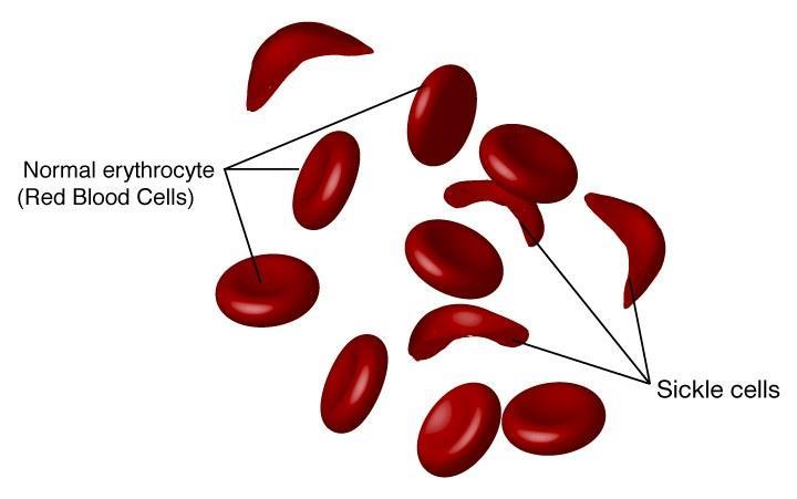 Alyuvarların orak şeklini alması Hemoglobin geni sorumludur