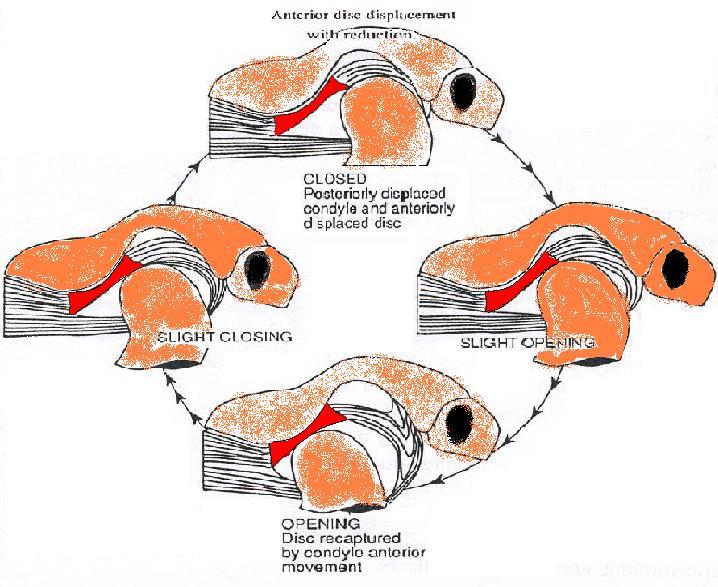 Disk anterior olarak öne kaydığında; posterior bant kondilin önünde kalır. Bilaminar bölge anormal olarak gerilir ve incelir.