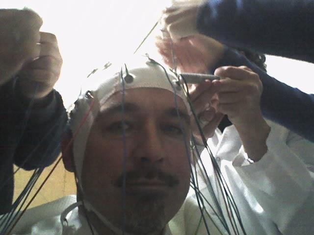 EEG AS A POSSIBLE DIAGNOSTIC TOOL FOR MILD