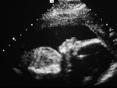 Prenatal Dönemde Hidronefroz Prognostik Faktörler: AP Çap Kalisiyel