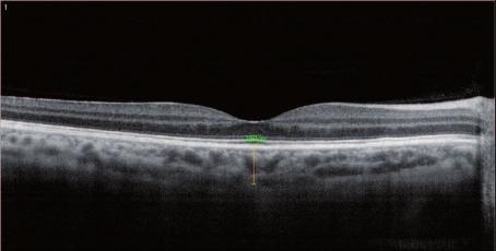 nılmıştır, bu modda birbirine dik olan 6-mm doğrular ile 1024 kesit almaktadır. Ölçümler için sadece nazal ve temporal kesitler kullanıldı.