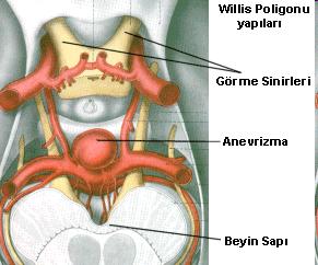 SAK 2 Sakkuler anevrizmalarıun %85 Willis poligonunun oluşturan arterlerde oturur.