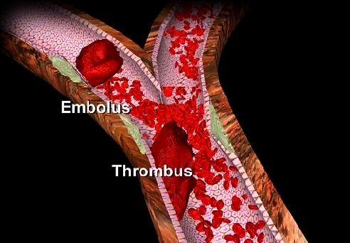 Bir emboli ile arterin