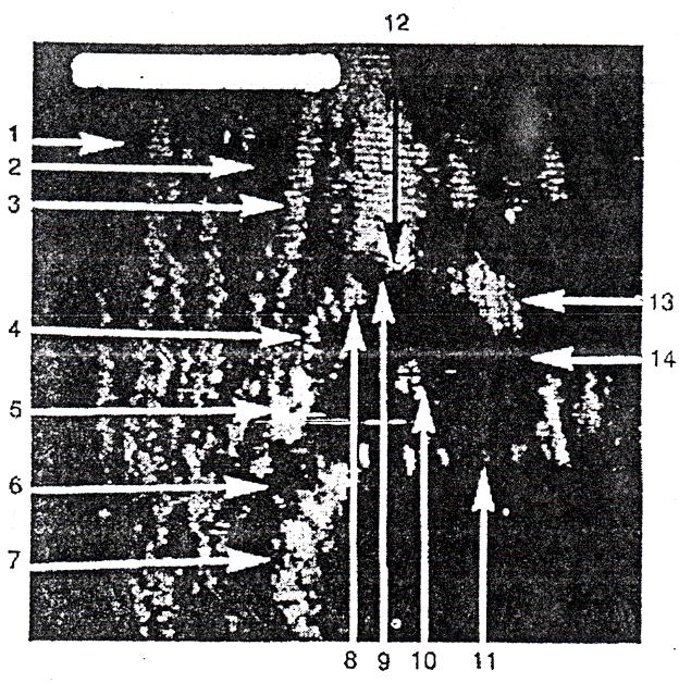 Buna göre kalça USG için gerekli olan noktalar şunlardır (Şekil 18,19): a) Asetabular fossada iliyak kemiğin alt kenarı b) Koronal kesitte asetabulumun en derin noktası c) Asetabuler labrum Bu üç