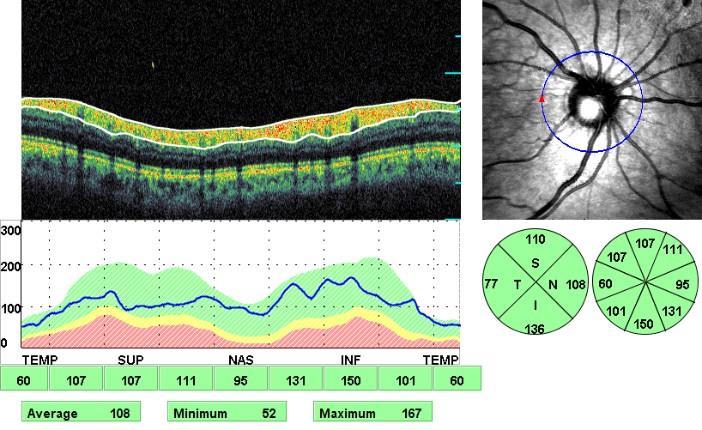 Dicle Tıp Dergisi / Dicle Med J (2018) 45 (3) : 335-340 makula dejenerasyonu, üveit, retinal ve koroidal vasküler hastalık, geçirilmiş retinal cerrahi, oküler travma ya da optik nöropati öyküsü olan,