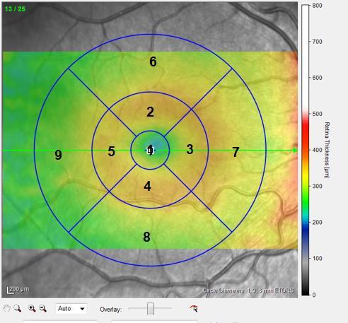 Hastaların glokom ilacı kullanım öykülerinin olmaması, göz içi basınçlarının 21 mm Hg yi geçmemesi, tipik glokomatöz optik nöropati bulgularının olmaması ile glokom tanısı dışlandı.