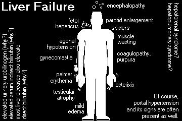 Karaciğer yetmezliğinin periferik bulguları ve/veya Terry s Kc