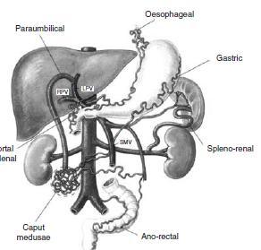 Varisten Kanama Olasılığı Kollaterallerin Oluştuğu Anatomik Yerler Varis büyüdükçe duvar incelir, gerilim ve kanama olasılığı artar G= B x Ç/DK Gastroözofageal varisler Rektal varisler Kaput meduza