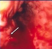 Tedavi: Genel Prensipler Oral beslenme durdurulur IV yol açılır (santral venöz kateter) Nazal oksijen desteği Unstabil olgularda Foley kateteriyle idrar çıkışının kontrolü Nazogastrik sonda Kan