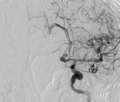 A b c d e Şekil 1: (49 Yaşında Erkek hasta) Kanamış Sol A1 den dolan anterior komunikan arter anevrizması Balon yardımlı Koil işlemi yapılan olgu.