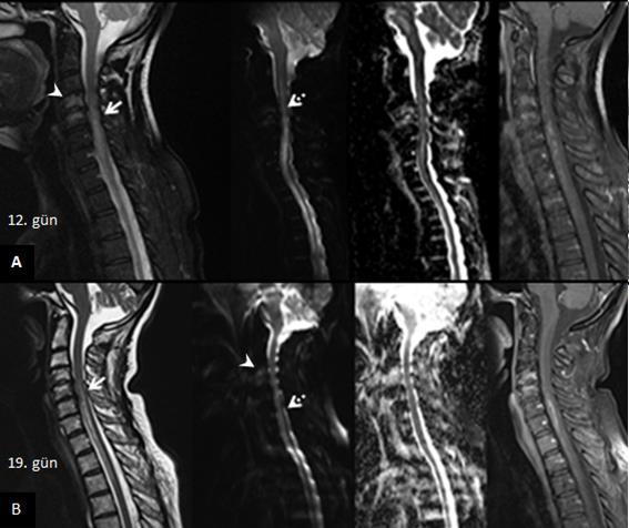 Akut anterior spinal arter oklüzyonu Resim 2A. 12.