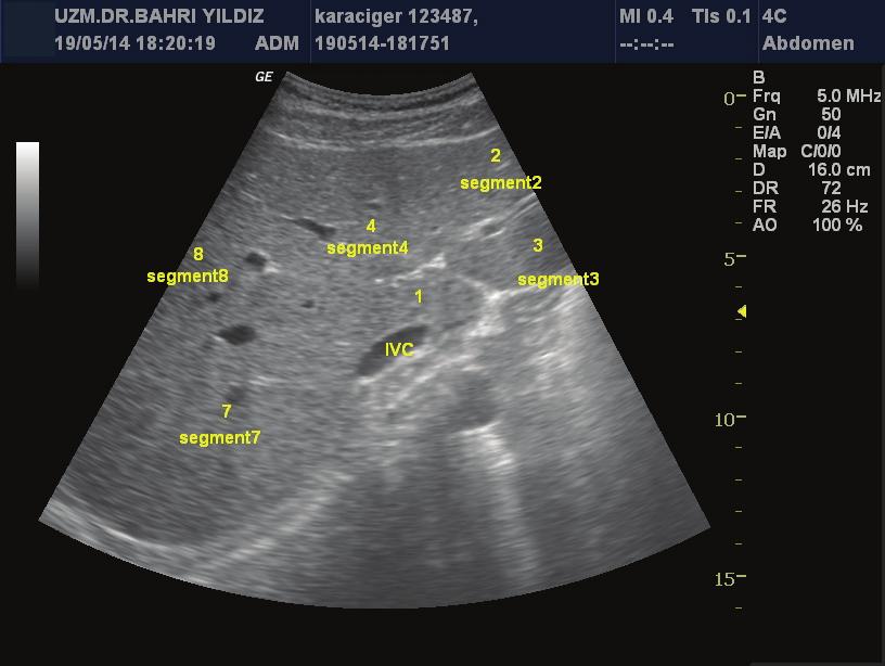 10 Temel Ultrasonografi COİNEAD SEGMENTAL ANATOMİSİNE GÖRE KARACİĞER SEGMENTLERİ Karaciğer