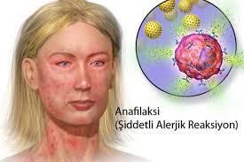 Anafilaksi Sistemik anafilaksi önceden duyarlı duruma geçmiş bir kimsede antijen uyarımına