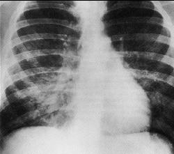 analizde akciğer enfeksiyonlarının lökodepleted grupta anlamlı olarak daha az
