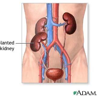 1970 lerin başında Opelz ve ark transplant öncesi allojenik kan transfuzyonu yapılan hastalarda renal allograft