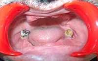 Resim 1. Hastanın tedavi öncesi ağız içi görüntüsü. gingivitis bulunduğu gözlendi (Resim 1). Radyografik inceleme sonucunda, 36 nolu dişte periapikal radyolusensi tespit edildi.