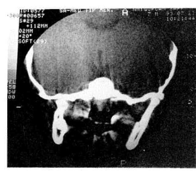 Resim 1,2,3. Olgunun tedavi öncesinde alınan cephe fotoğrafı, postero-anterior filmi ve tomografik kesit örneği. Tüm kayıtlarda mandibulanın sağa deviasyon yaptığı izlenmektedir. hipoplaziye sahip 8.